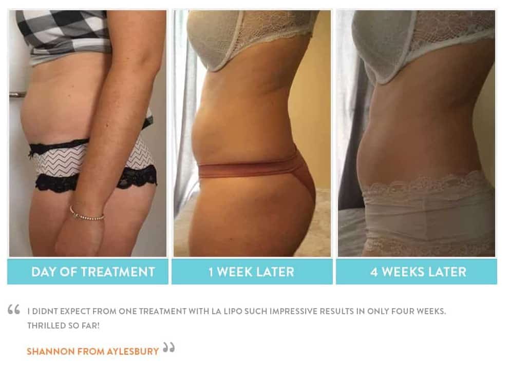 before, Cryolipolysis Barking