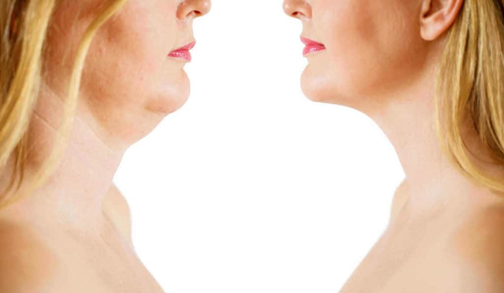 Double Chin treatment Barking before and after results