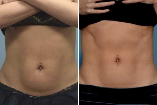 body sculpting FAQs Barking