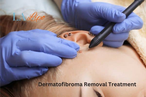 Dermatofibroma Removal Treatment Barking