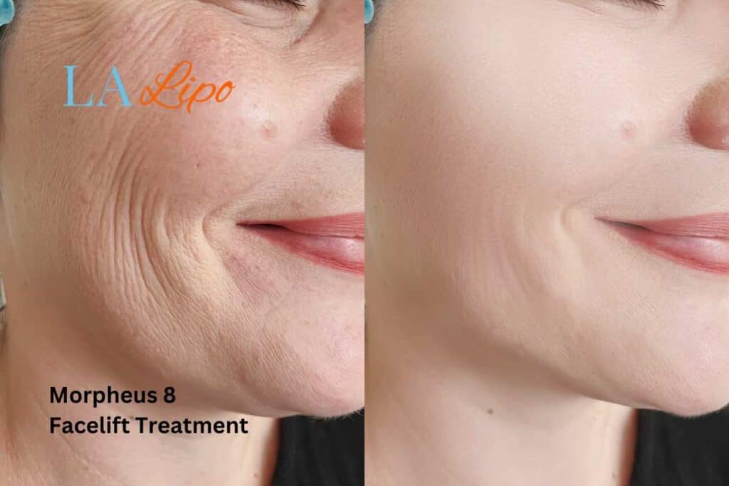 Morpheus8 Treatment Barking for flawless skin! Call us today!