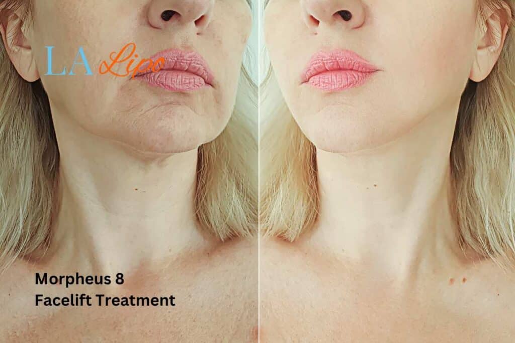 Turn back time with Morpheus8 Treatment Barking