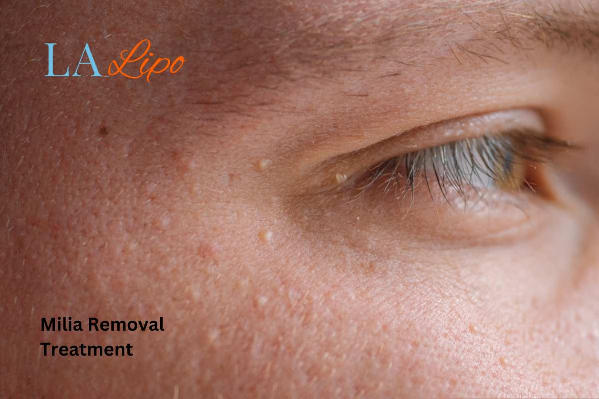 Cryopen Milia Removal: Is It the Easiest and Safest Option Barking?