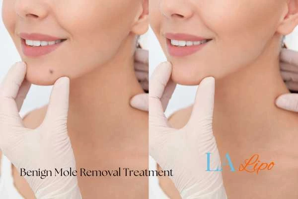 woman's before and after mole removal Barking results