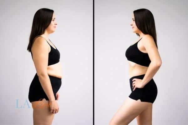 image of woman before and after results of LA-EMS Body Sculpting Barking to help treat Diastasis recti