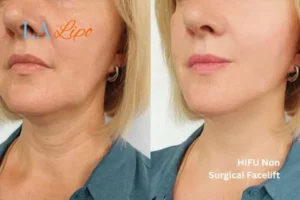 hi-fu for wrinkles Barking before and after results
