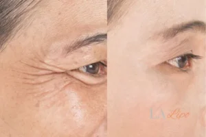 Before and after results of woman - HI-fu wrinkles reduction treatment Barking