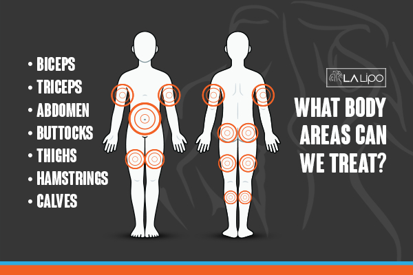 Graphic to show areas you can have LA-EMS Body Sculpting Barking treatment.