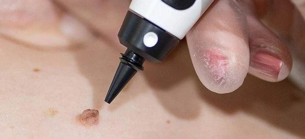 skin tag removal using cryopen Barking