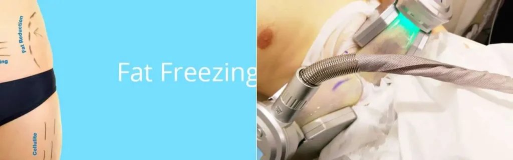 Fat freezing Barking on multiple areas of the body