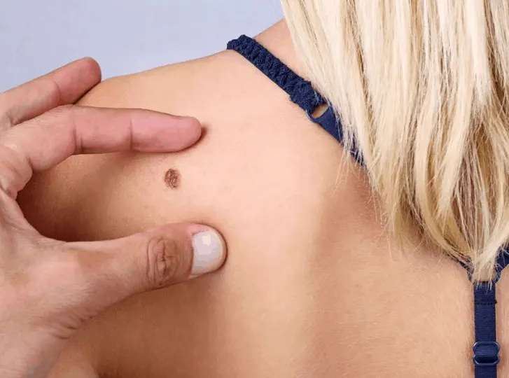 woman having mole removal Barking consultation before treatment.