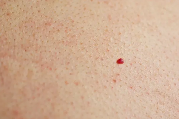 close up of a cherry angioma Barking
