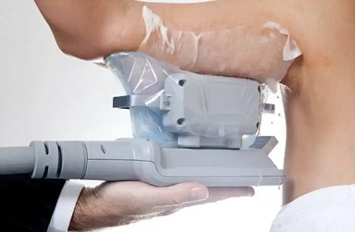 Picture of fat freezing Barking on the upper arms.