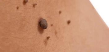 image of a skin tag Barking