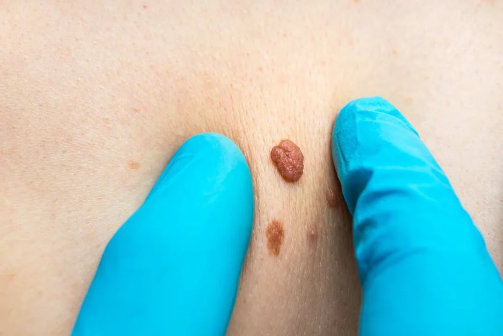 Consultant examining a skin tag Barking