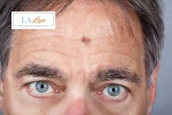 Solar Lentigo Removal Barking image of man with mark on his forehead