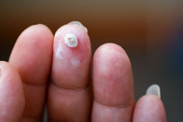 wart on person finger - cryotherapy to treat from LA LIPO Barking