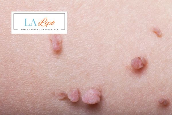 Does cryopen skin tag removal Barking hurt? Find out now call our team today!
