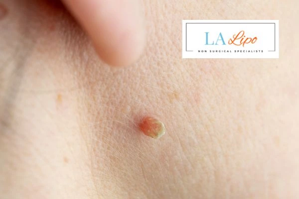 Book skin tag removal Barking today speak to our team now!