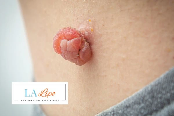 Interested in skin tag removal Barking? Concerned about the pain? Find out more today!