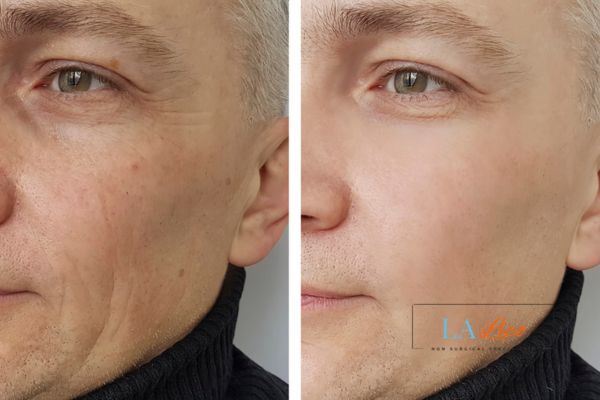See the amazing results of Morpheus8 Treatment Barking!