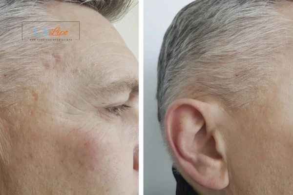 Mens Before & After Morpheus 8 Results Barking