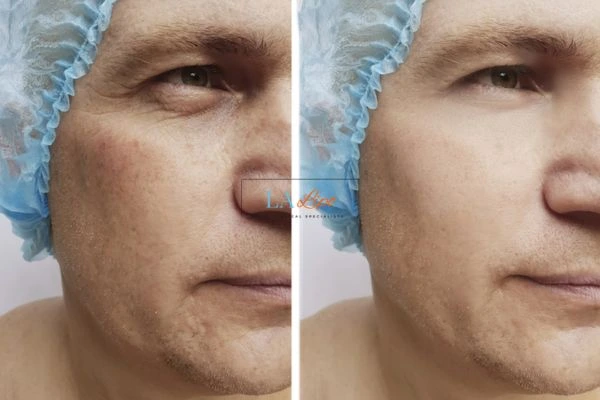 Before and after Morpheus 8 Results Barking