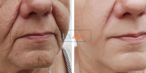 Older lady deeper wrinkle reduction - LA LIPO Morpheus 8 Results Barking