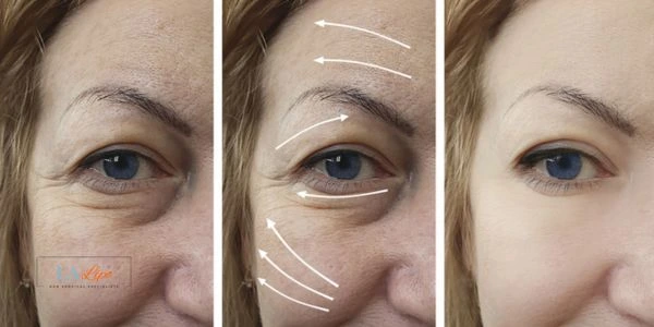 Amazing eye lift Morpheus 8 results Barking