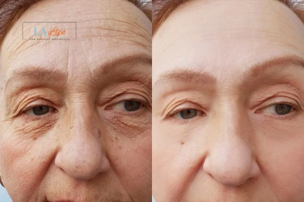 The powerful benefits of Morpheus8 Treatment Barking - Call Our team today!