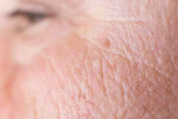 close up picture of a woman's face showing an age spot Barking