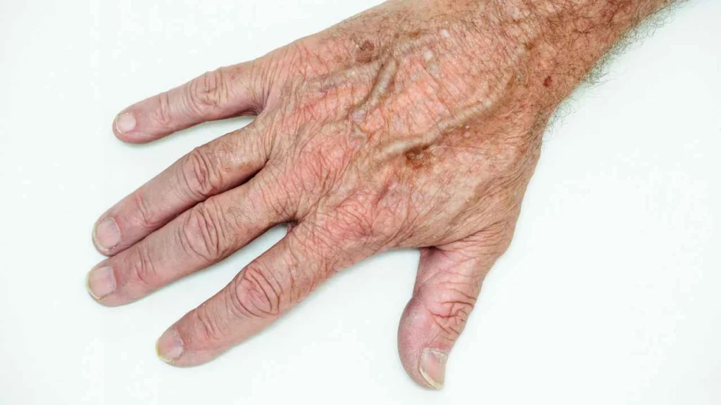 Male hand showing age spot Barking