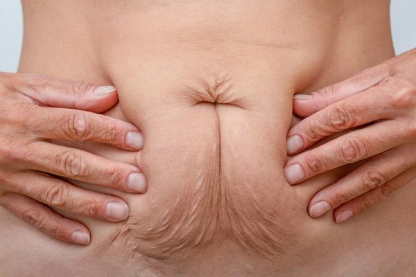 Image of a woman's stomach with loose skin - example of skin tightening Barking options